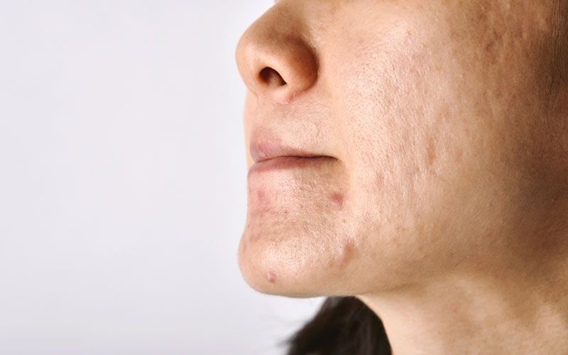 Wajah Sedang Berjerawat, Amankah Lakukan Facial?