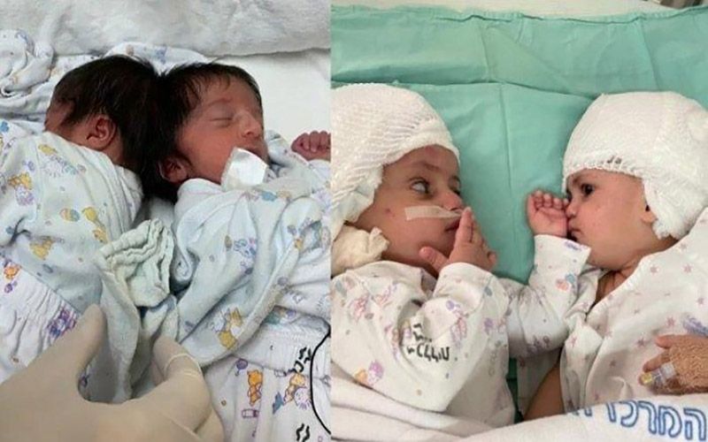 Dokter Muslim Berhasil Melakukan Operasi Pemisahan Bayi Kembar Siam Asal Israel