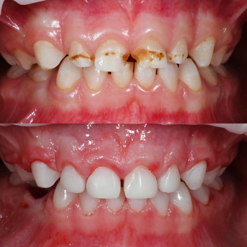 Treating Decay and Restoring Baby Teeth Under General Anaesthesia