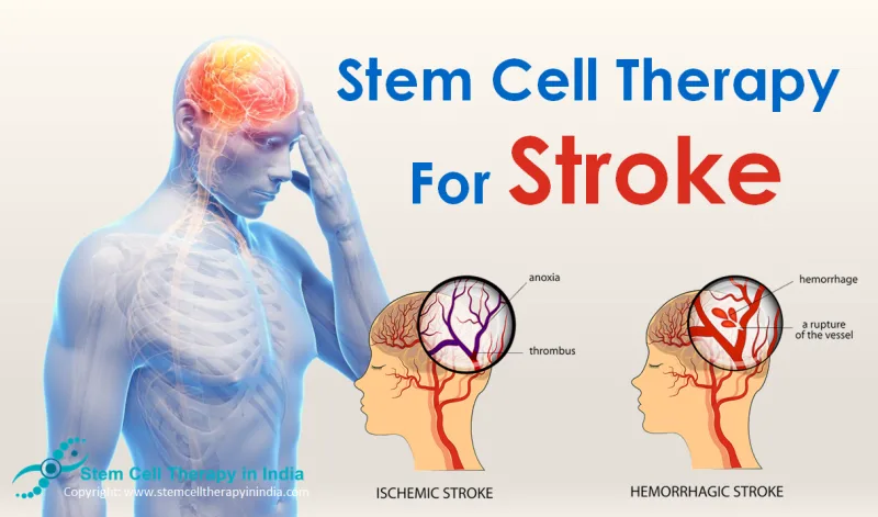 Stem Cell Therapy For Stroke