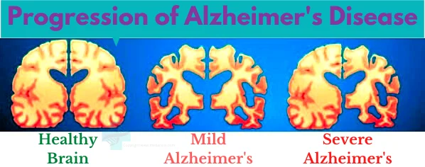 Stem Cell Therapy for Alzheimer’s in Mumbai, India - MedAcess