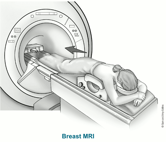 رنين الثدي MRI Breast