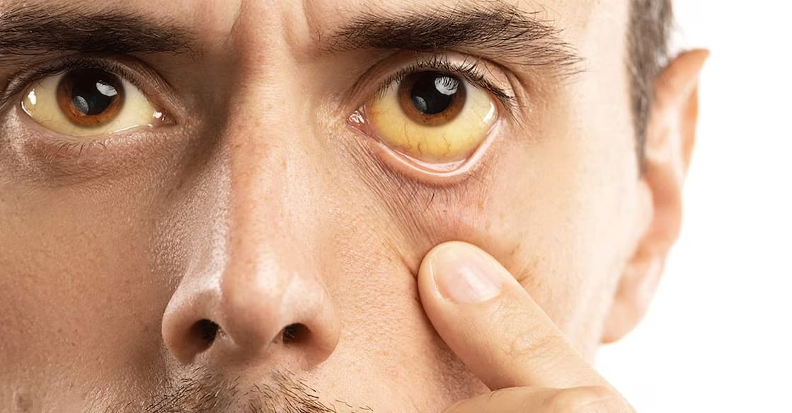 ⚠️Jaundice Alert in Kerala: Symptoms, Prevention, and Cure"