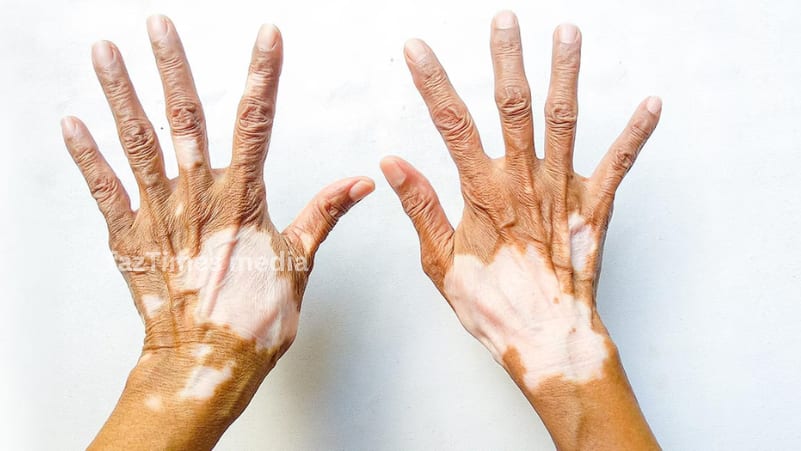 How do you stop vitiligo from spreading naturally