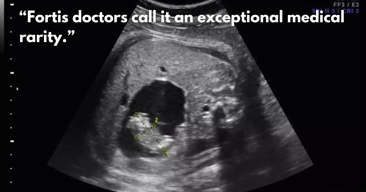 Doctors Remove Parasitic Twin from Newborn in Rare Surgery