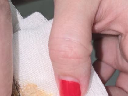 Красноярке пришлось удалять имплант из-за воспаления после пластики груди