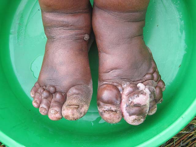 Podoconiosis 2