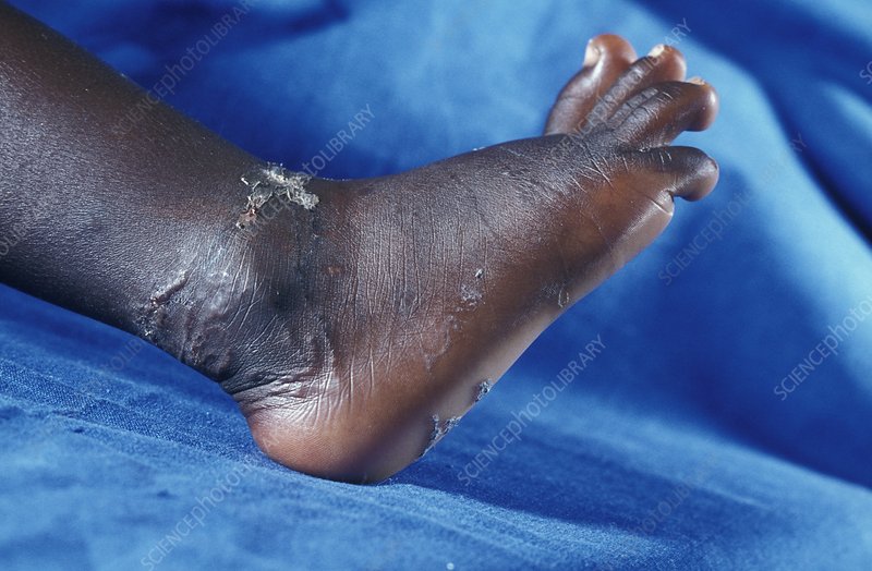 Hookworm 3