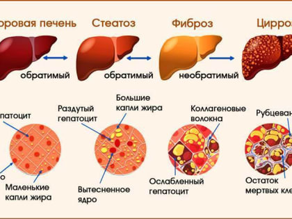 Актуальные вопросы диагностики лечения и профилактики цирроза печени обсудили на врачебной конференции в ЦГБ