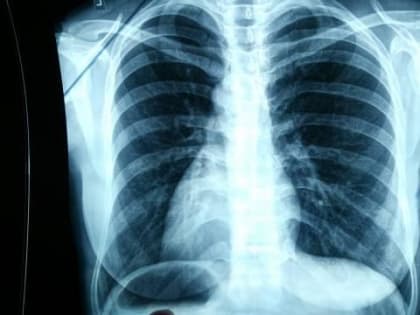 В Мариинско-Посадском районе Чувашии больного туберкулезом будут лечить принудительно