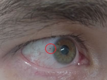 В Чувашии офтальмологи помогли мужчине, который косил траву и травмировал глаз