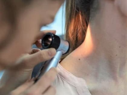 260 человек приняли участие в акции «Сфотографируй свою родинку»