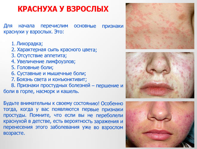 Краснуха у взрослых: симптомы и лечение, фото в первый день