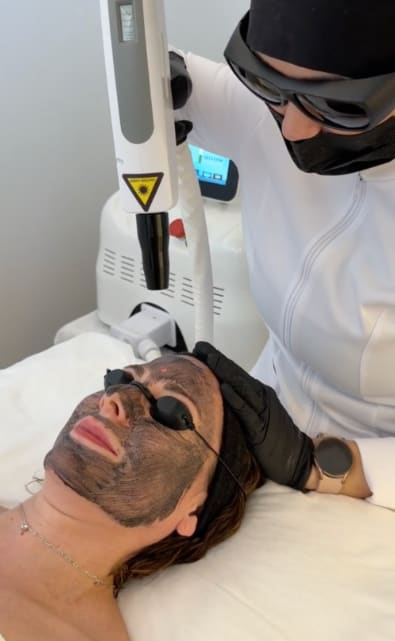 Carbon Peel