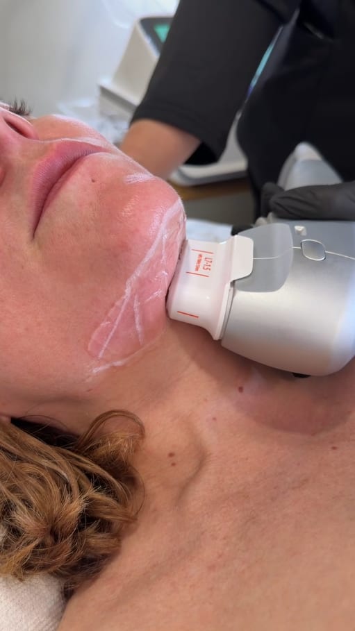 HIFU facial