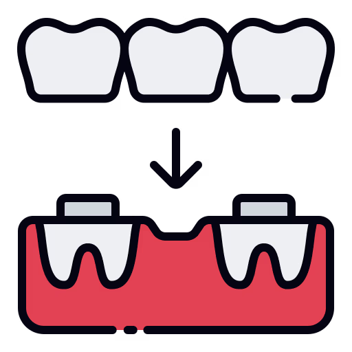 Puentes dentales
