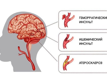 День борьбы с инсультом