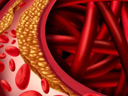 Бляшки растворятся: напитки, которые снижают уровень холестерина