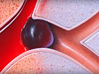 Тромбы рассосутся: обычные продукты, которые разжижают кровь и препятствуют тромбообразованию