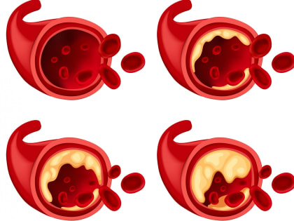 Холестерин в норме: эффективные домашние средства, которые снижают уровень плохого холестерина