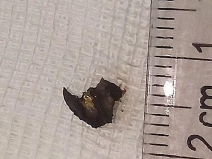 В Новороссийске медики вытащили магнитом из глаза пациента инородное тело