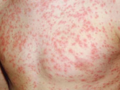 В Европе быстро распространяется опасная для детей болезнь