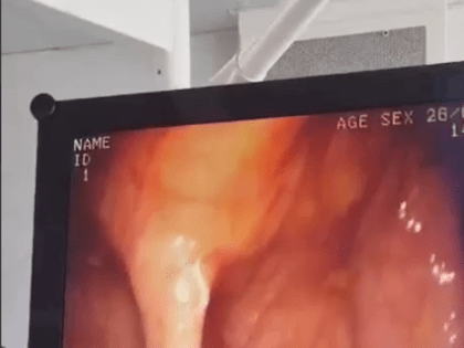 Клубок паразитов обнаружили в кишечнике пациента в Новороссийске