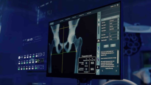 Planificación de un reemplazo de cadera sobre la radiografía en el sistema MAKO
