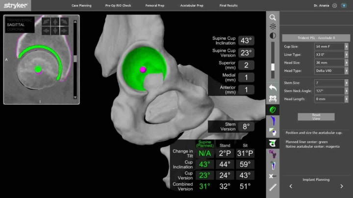 Pantalla del sistema MAKO con la planificación 3D de un implante de cadera