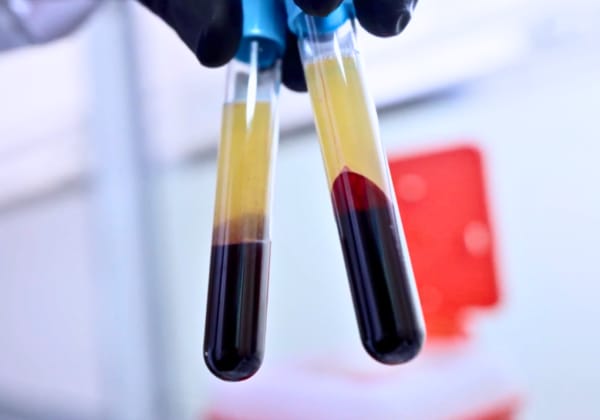 PRP - Plasma Rico en Plaquetas