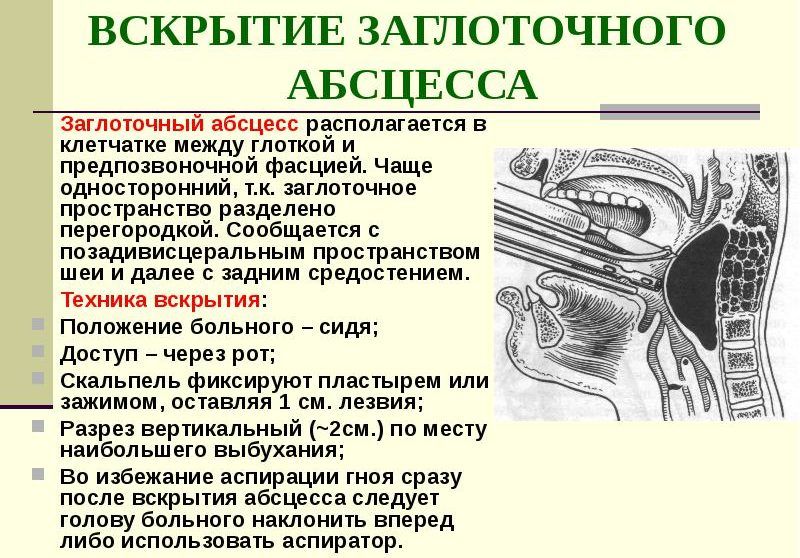 Инструмент абсцесс