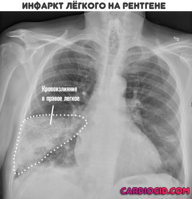 Тромбоэмболия легочной артерии пневмония. Инфаркт пневмония рентген. Инфаркт пневмония на рентгене легких. Инфаркт пневмония на рентгенограмме. Тэла пневмония рентген.