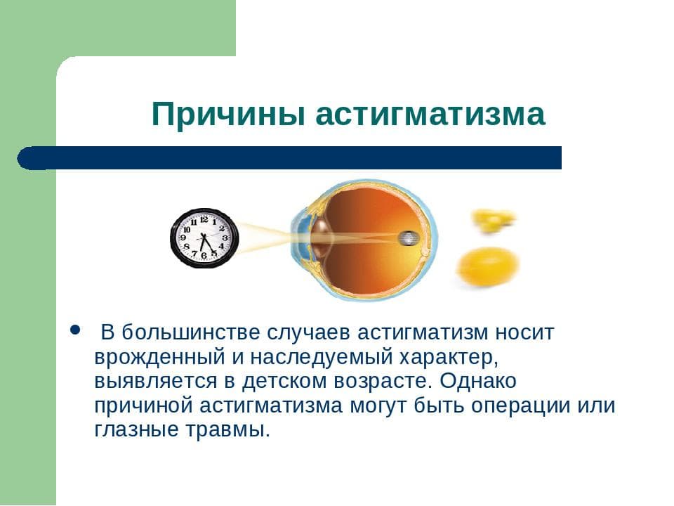 Астигматизм что это. Астигматизм причины возникновения. Астигматизм глаз у детей причины. Дальнозоркий астигматизм. Глазные заболевания астигматизм.