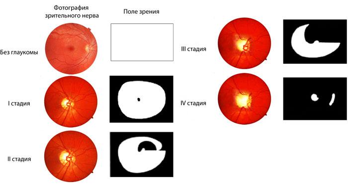 Классификация глаукомы