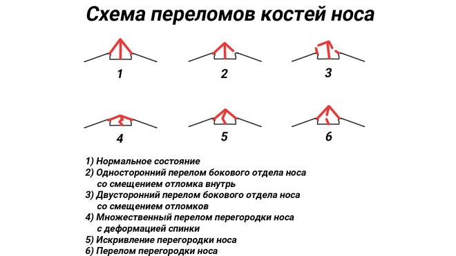 Закрытый перелом носа карта вызова