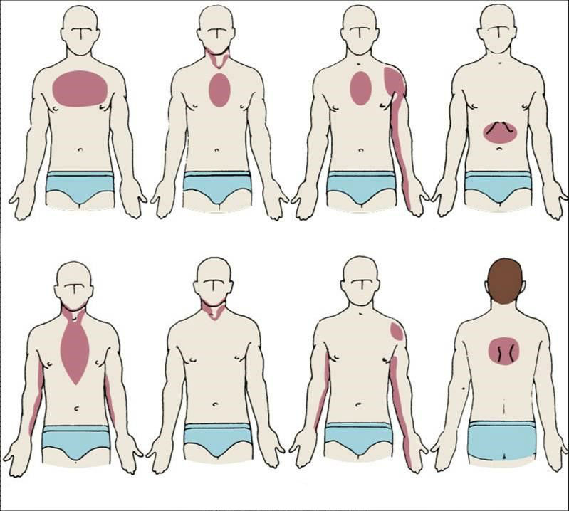 Болит сердце грудная клетка. Атипичная локализация боли при инфаркте миокарда. Иррадиация при инфаркте миокарда. Иррадиация боли при инфаркте миокарда. Локализация боли за грудиной.