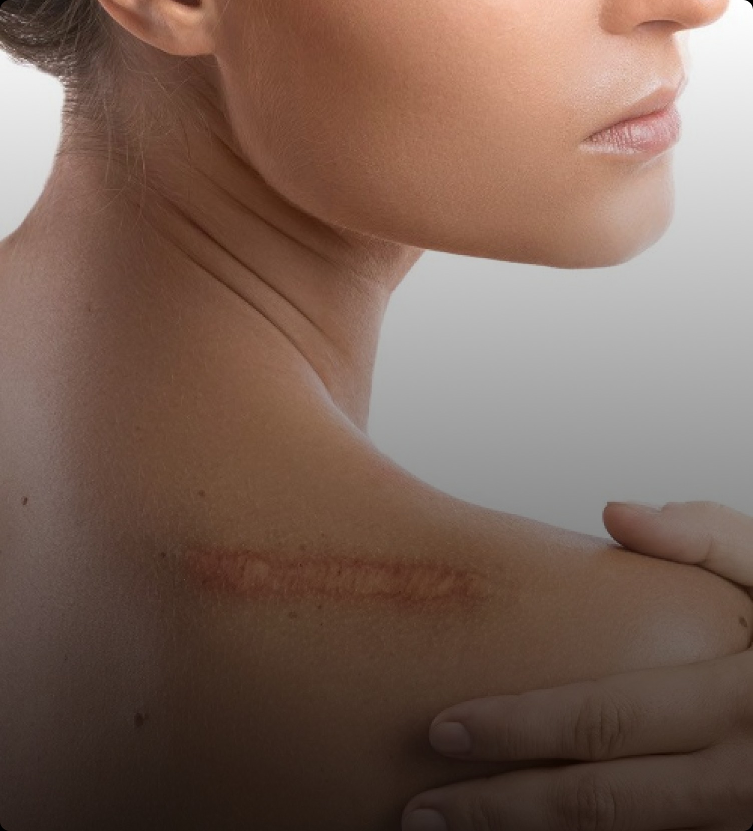 Keloid Treatment Malaysia: Expert Scar Care & Confidence