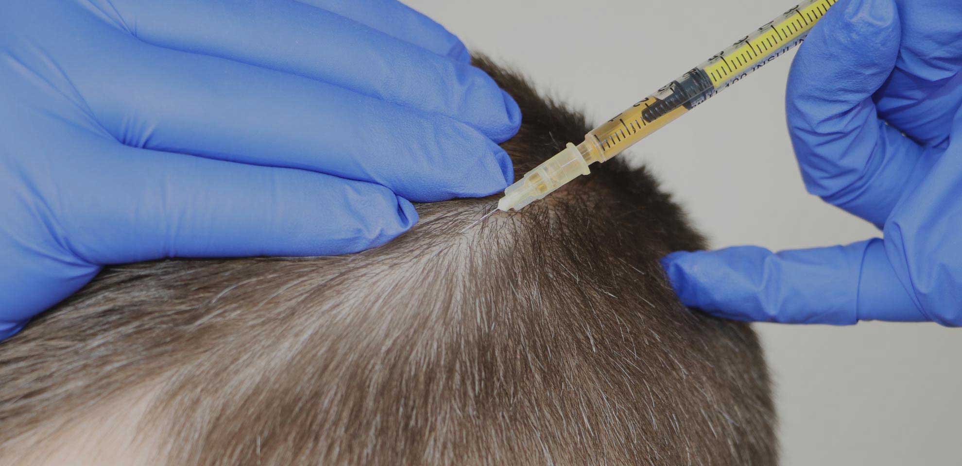 Mesotherapy for Hair Cost in Delhi Gupta MBBS, MD - SKINOS Mesotherapy for Hair Cost in Delhi Gupta MBBS, MD - SKINOS