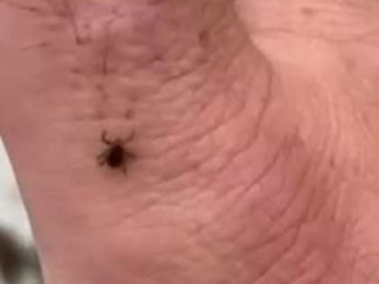 Сезон открыт: житель Невельска снял с себя клеща