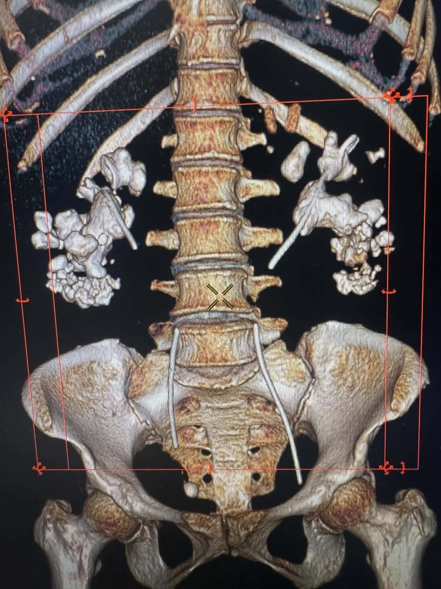 Kidney complications| Kidney stone removal surgery for my Mother - Image 3