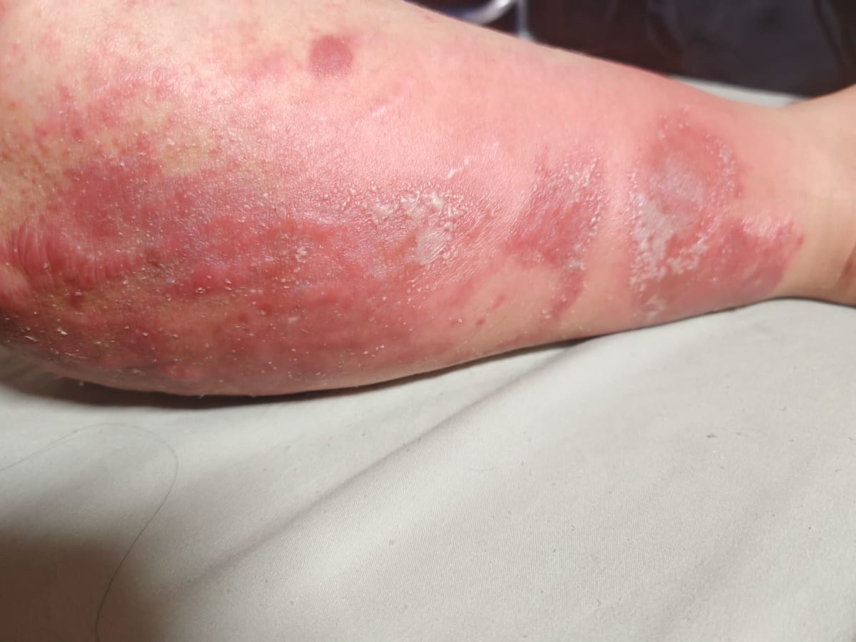 Help Me Take the Next Step in My Psoriasis Journey - Image 1