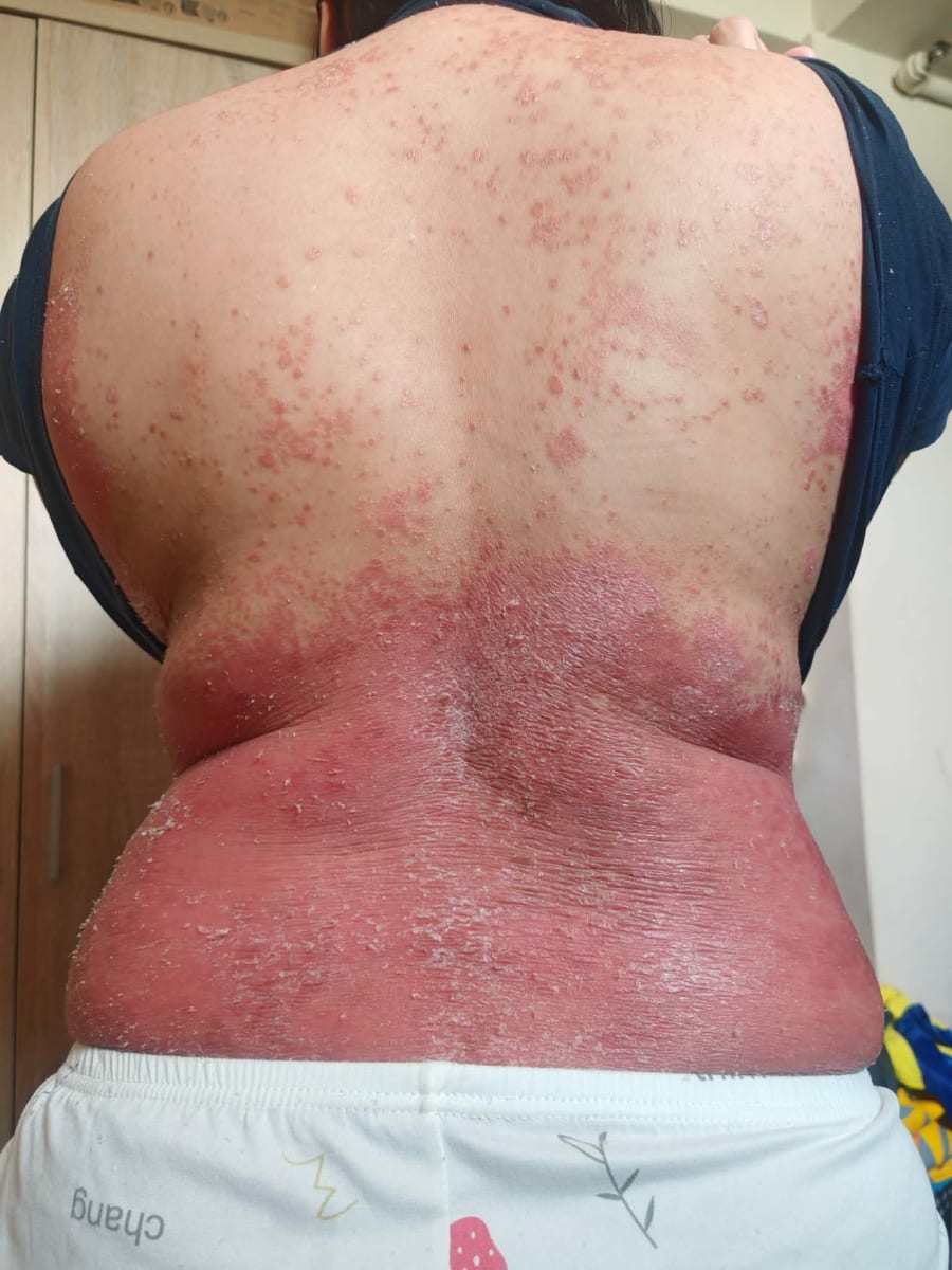 Help Me Take the Next Step in My Psoriasis Journey - Image 2