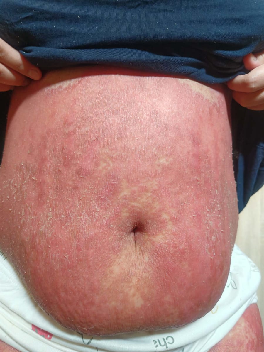 Help Me Take the Next Step in My Psoriasis Journey - Image 3