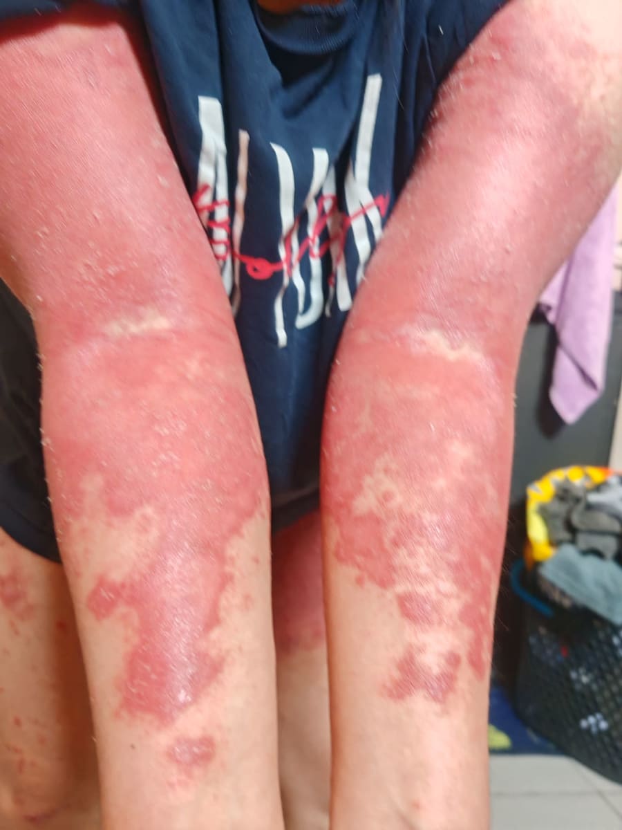 Help Me Take the Next Step in My Psoriasis Journey - Image 4