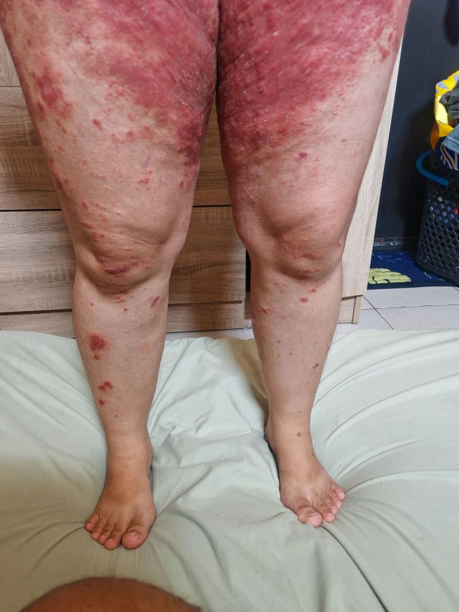 Help Me Take the Next Step in My Psoriasis Journey - Image 5