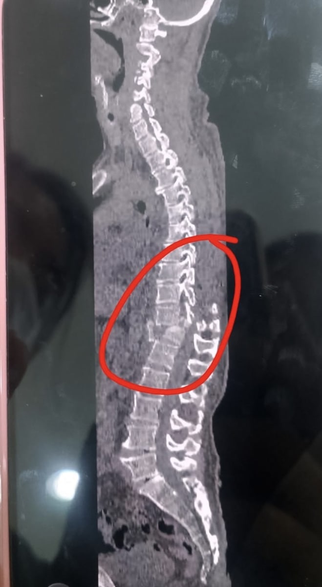     Urgent Help Needed for Uncle Roque’s Spinal Surgery - Image 1