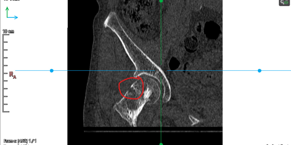 Help Mama Walk Comfortably Again – Partial Hip Replacement Fund