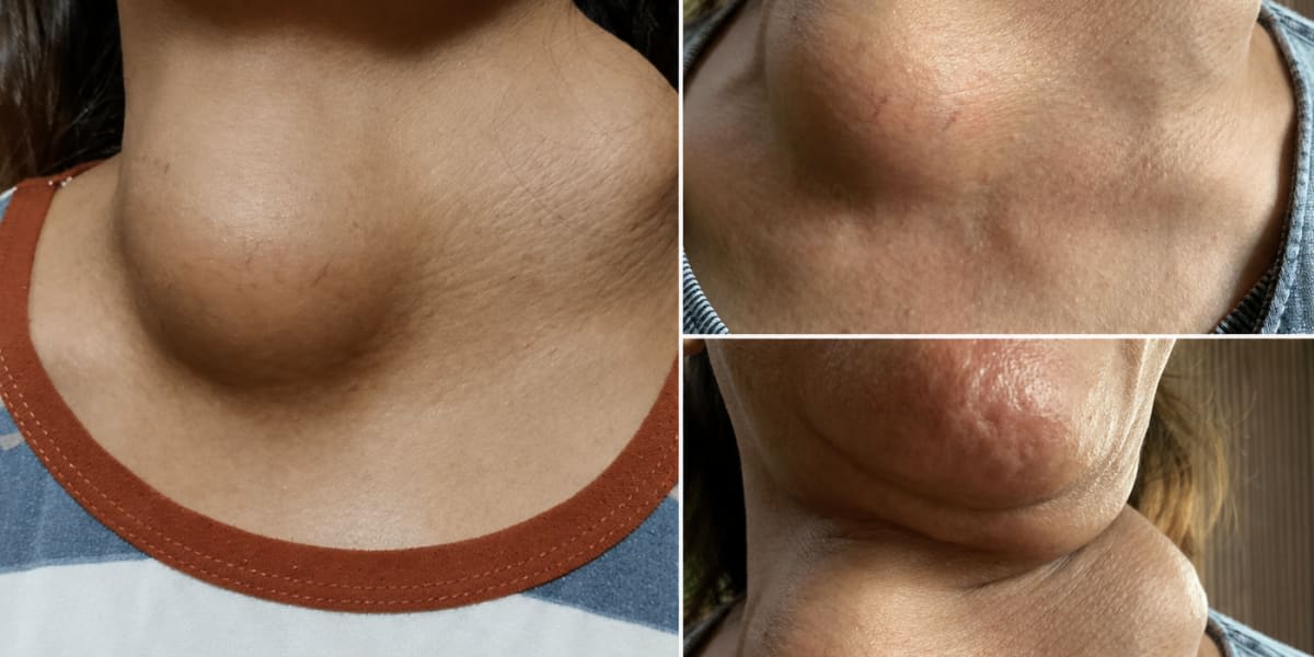 Progress Update on Lump Growth