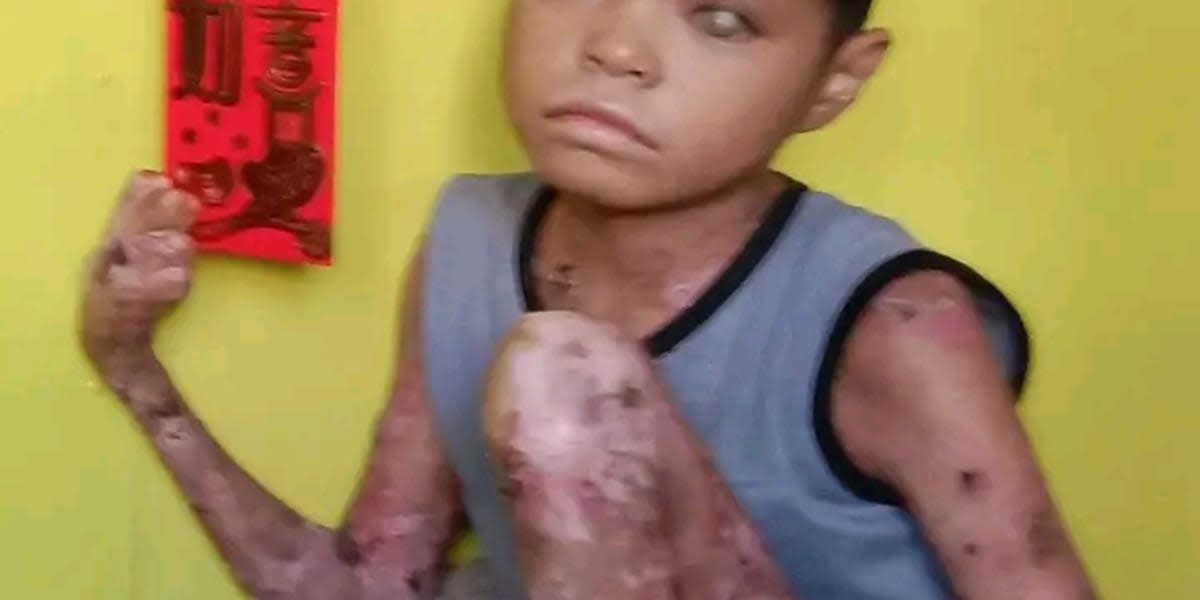 Helps Andric to recover from Skin cancer
