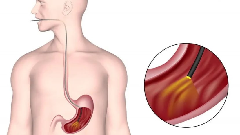 Emergency endoscopy saves patient from life-threatening gastrointestinal bleeding post heart attack
